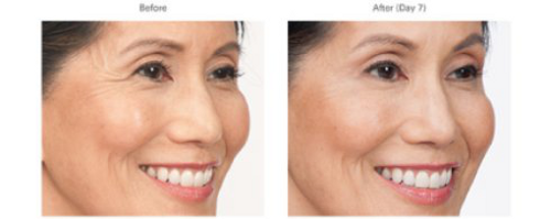 botox-before-and-after-photo