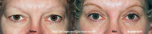 eyelid_surgery1